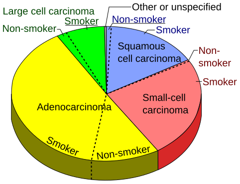 File:Pie chart of lung cancers.svg